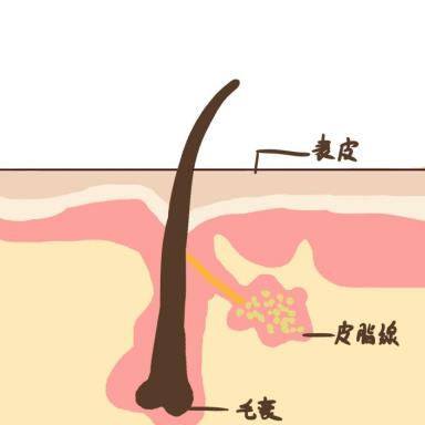 甲硝唑凝胶治痘痘好吗？别说，效果还不错！