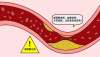 颈动脉硬化斑块怎么办