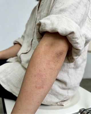 湿疹很痒如何止痒？