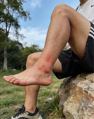 手脚酸痛能用伤科灵吗？